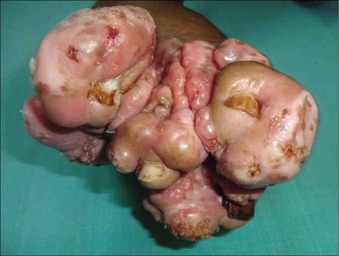 Surface of the toes showing areas of verrucosity; nails visible on each of the toe