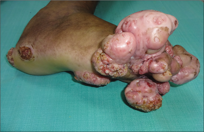 Lateral view showing verrucosity on the surface of the nodular lesions and erythematous plaques with verrucosity