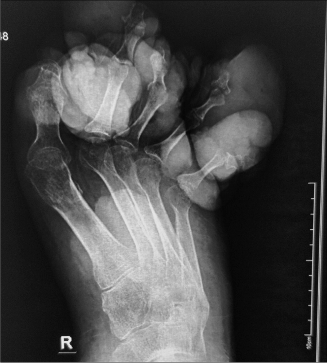 X-ray of the right foot showing grossly distorted toes bones