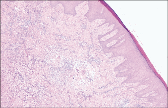 Scanner view showing hyperkeratotic and acanthotic epidermis and the presence of multiple granulomas in deep dermis (H&E, ×40)