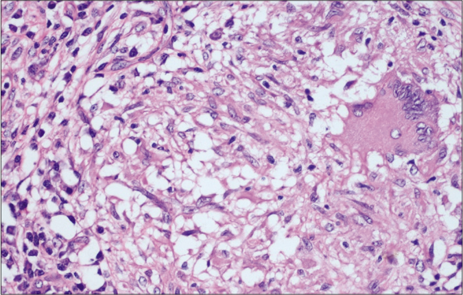 High power view showing epithelioid cell granuloma with Langhans type giant cells and lymphohistiocytic infiltration in the surrounding area (H&E, ×400)
