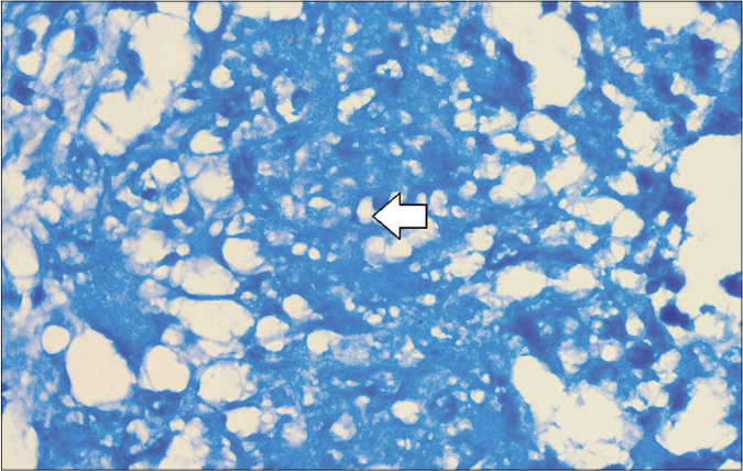 Modified Ziehl–Neelsen stain showing acid-fast bacilli (Modified ZN, ×1000)