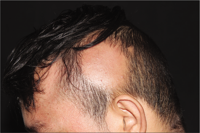 a Area of non-scarring alopecia in the left parietal region