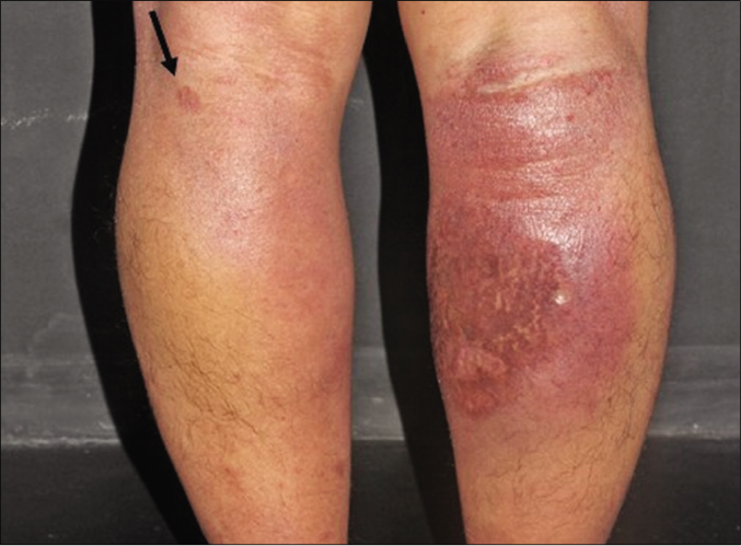 The left leg with patches and the right calf with an infiltrated plaque with an erythematoviolaceous surface