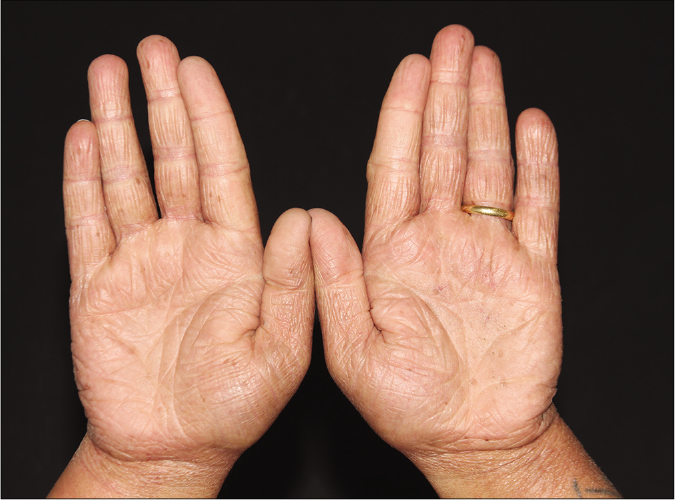 Hands with diffuse erythema and infiltration