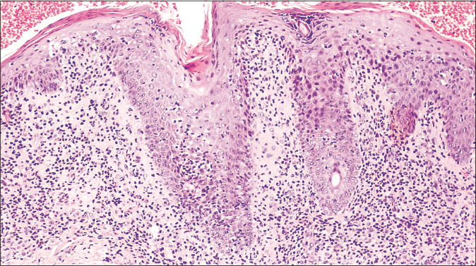Histological findings of the parietal biopsy revealed infiltration of the follicular epithelium by small, medium-sized lymphocytes. Mucinous degeneration was not seen (hematoxylin and eosin 100×)