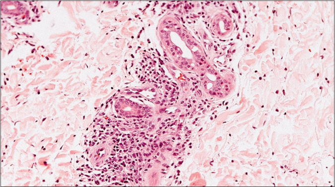 Biopsy of the palm revealed small collections of medium and large size atypical lymphocytes within the acrosyringium (hematoxylin and eosin 200×)