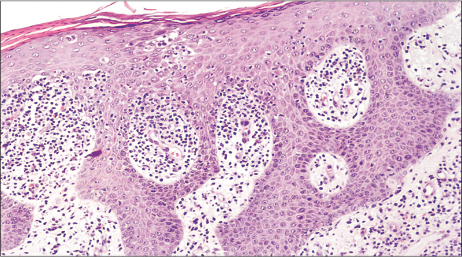 Biopsy of the leg revealed epidermotropism of small and medium size lymphocytes (hematoxylin and eosin 100×)
