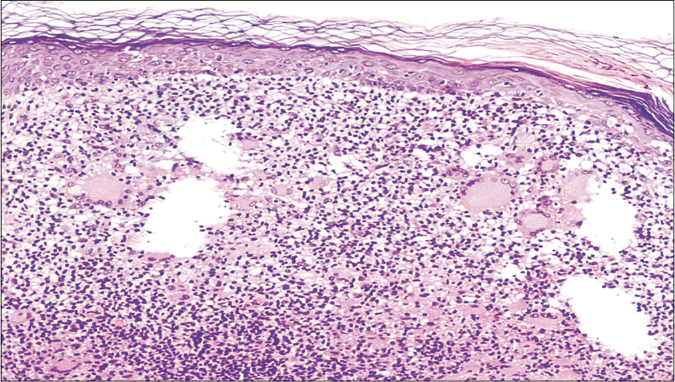 Skin biopsy from inguinal region with superficial atypical lymphocyte infiltrate, granulomas and multinucleated giant cells (hematoxylin and eosin 100×)