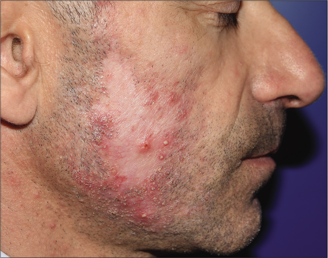 Folliculitis decalvans of the beard before treatment: central scarring alopecia area surrounded by scaly-crusty lesions and pustules of the right cheek