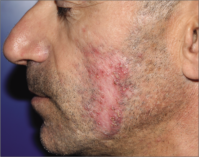 Folliculitis decalvans of the beard: detail of the left cheek