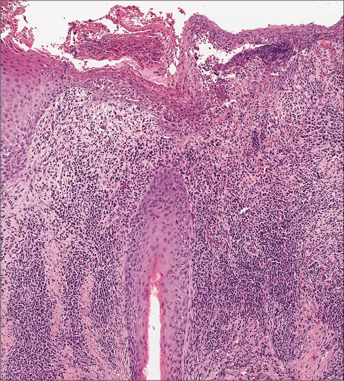 tufted folliculitis histology