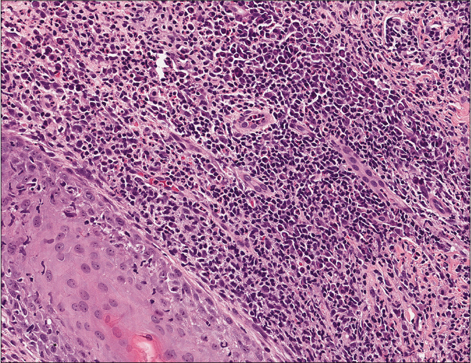 Detail of perifollicular infiltration showing the presence of plasma cells, neutrophil and eosinophil granulocytes (H and E, ×400)