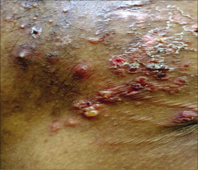 Case 3 – Grouped vesicles, erythematous plaques, crusting, and scaling distributed on the upper back