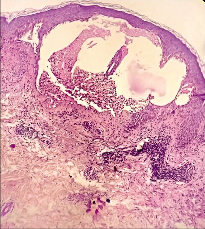 Case 3 – Subepidermal blister showing collections of predominantly neutrophils with perivascular inflammatory infiltrate of lymphocytes and histiocytes (H and E, ×100)