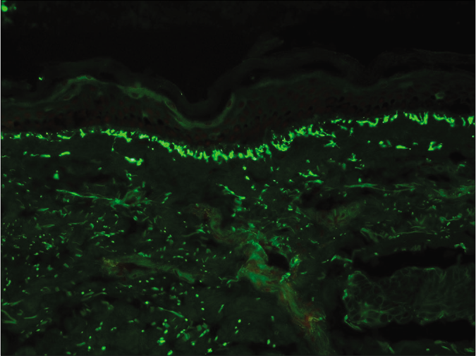 Case 1 – Fibrillar deposits of IgA seen as linear streaks along the dermal papillae and dermoepidermal junction (fluorescein isothiocyanate, ×200)