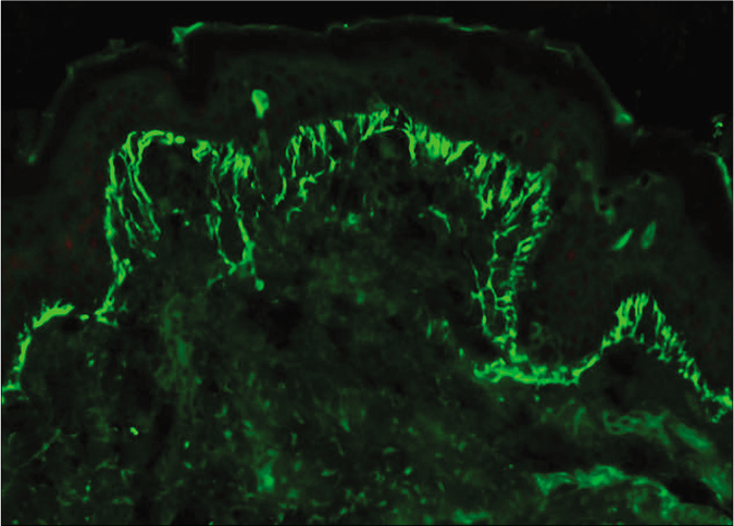 Case 3 – Fibrillar staining of basement membrane zone and dermal papillae with IgA deposits (fluorescein isothiocyanate, ×400)