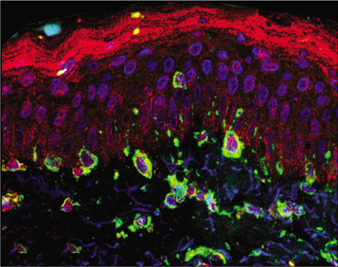 Overlapping direct immunofluorescence images in (a) melasma— cytoplasmic labeling of melanocytes and fibroblasts (×400). LC3B—red; vimentin—green; 4',6-diamidino-2-phenylindole—blue