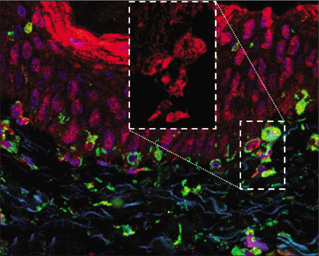 Overlapping direct immunofluorescence images in (b) the adjacent skin—cytoplasmic labeling of melanocytes and fibroblasts (×400). LC3B— red; vimentin—green; 4',6-diamidino-2-phenylindole—blue