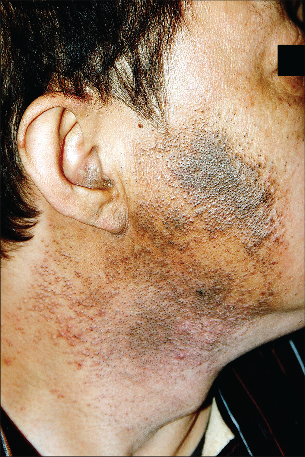 Open and closed comedones along with tender inflammatory papules in the irradiated area on the right side of his cheeks and neck