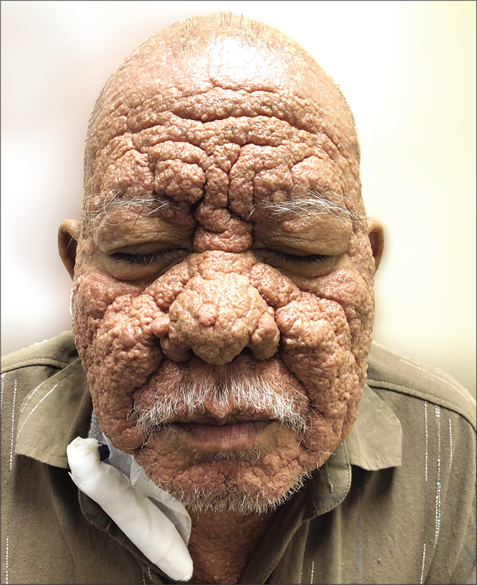 Multiple diffuse, greasy, dome -shaped umblicated papules on his face sparing the periorificial and nasolabial areas