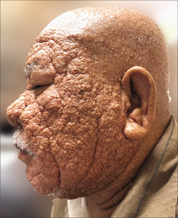 Multiple diffuse, greasy, dome- shaped umblicated papules seen on his face