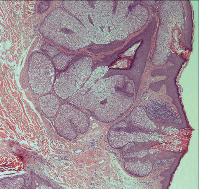 Light microscopy showing lobules’ expansion of the sebaceous glands around a central duct. The stroma is loose with foci infiltration of mononuclear cells. Deep dermis is unremarkable (H and E, ×40)