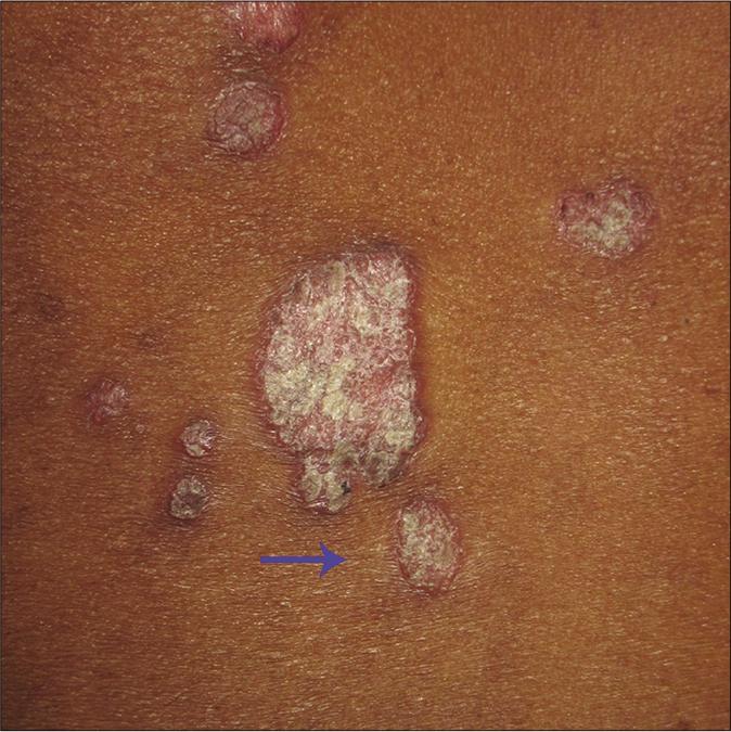 Psoriatic plaque (arrow) before the use of sandpaper