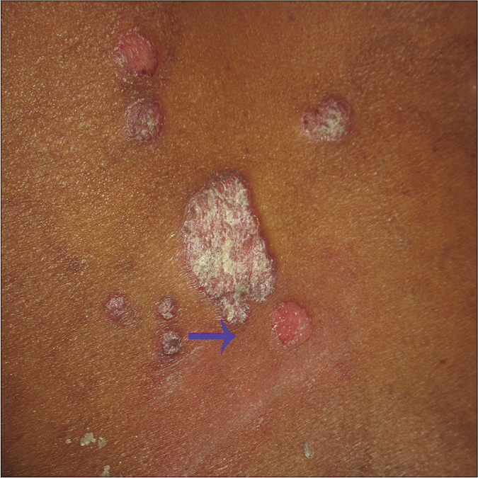 Psoriatic plaque (arrow) after the use of sandpaper, showing complete absence of the scales without bleeding points