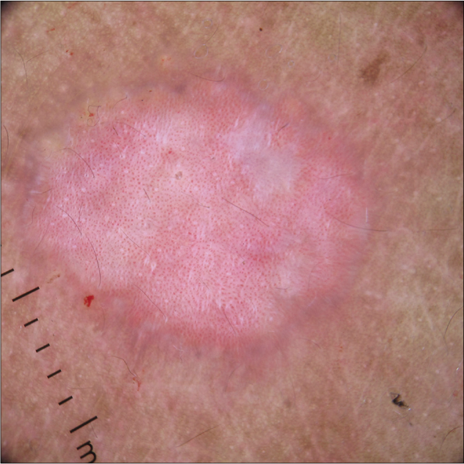 Dermoscopic image of the plaque demonstrating regularly distributed dotted vessels on a pinkish background (Dermlite DL4, ×10)