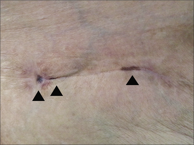 Physical examination revealed several well-demarcated, black macules along the linear scar line