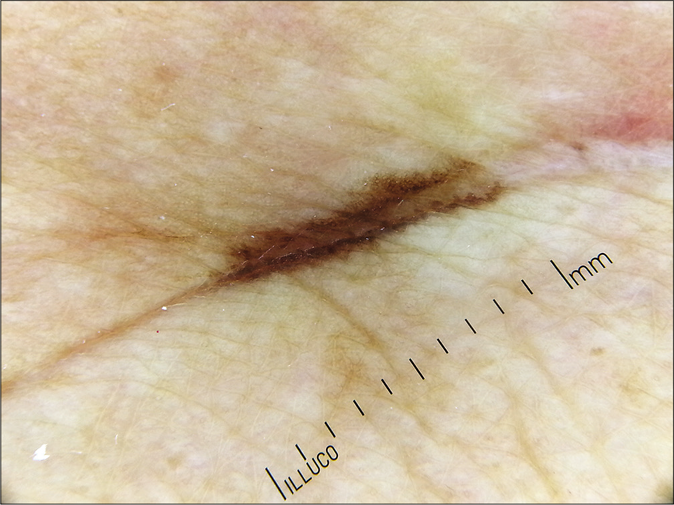 Dark brown irregular streaks confined to the linear scar line (original magnification, ×10)