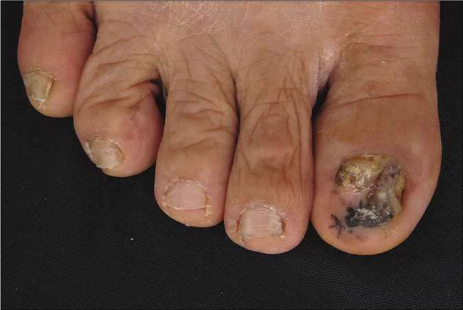 The acral lentiginous melanoma on the right big toe