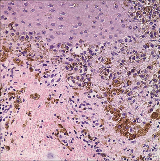 The biopsy on the scar revealed a lentiginous array of atypical melanocytes (hematoxylin and eosin, ×400)