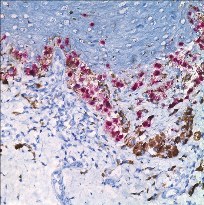 Atypical cells showing HMB45 stain positivity (HMB-45, ×400)