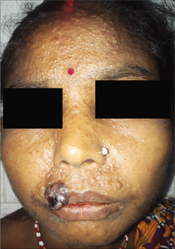 Nodular melanoma on the right side of upper lip with numerous papules of satellitosis and in-transit metastases bilaterally on upper lip, nose, medial portion of both cheeks and central forehead