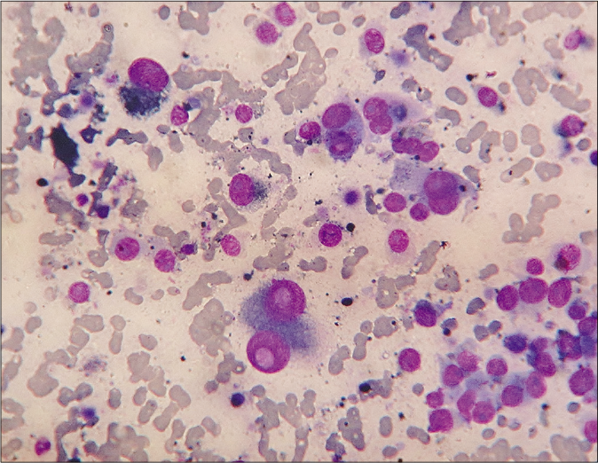 Cytologically, dispersed polyhedral melanoma cells with one-or-two eccentric rounded nuclei, gross anisokaryosis, prominent nucleoli, intranuclear cytoplasmic pseudoinclusions and intracellular as well as background extracellular melanin granules (Leishman-Giemsa, ×400)