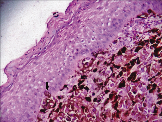 Histologically thinned-out epidermis with the dermis occupied by nests of melanoma cells. Note the singly infiltrating tumor cells (arrow) within the epidermis (hematoxylin-eosin, ×400)