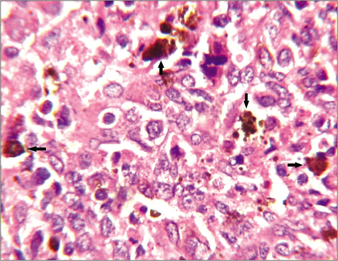 Histologically, in areas with sporadic presence of heavily-pigmented melanocytes (arrows), the tumor cells were better elicited as epithelioid in shape having large vesicular nuclei, often prominent nucleoli and abundant pale or clear cytoplasm (haematoxylin-eosin stain, ×1000)