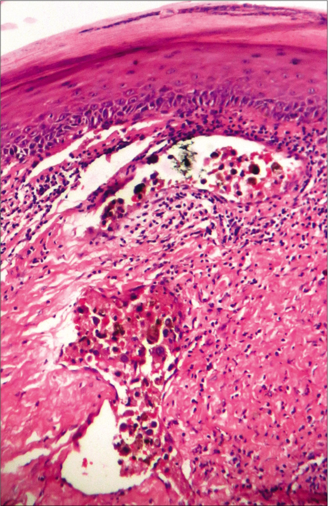 In-transit metastasis, featuring malignant melanocytes within dermal lymphatics (hematoxylin-eosin, ×100)