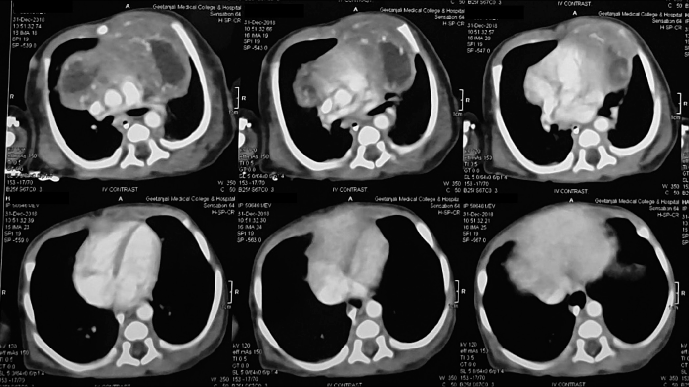 Anterior mediastinal mass on postnatal computerized tomography scan of chest