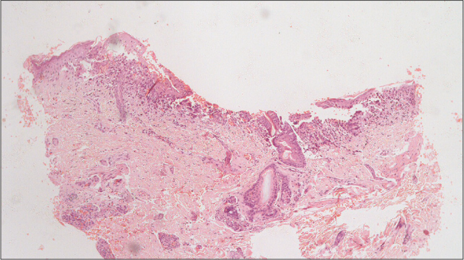 Dermal infiltrates of Langerhans cells showing reniform or infolded nuclei (H&E, ×40)