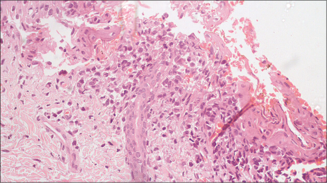 Dermal infiltrates of Langerhans cells showing reniform or infolded nuclei (H&E, ×400)