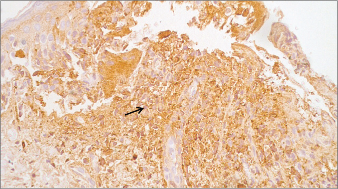 S100-positive immunostaining for dermal infiltrates (IHC S100, ×400)