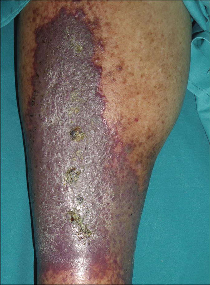 Clinical photograph of one of the patients’ lower leg showing the classical features of acroangiodermatitis