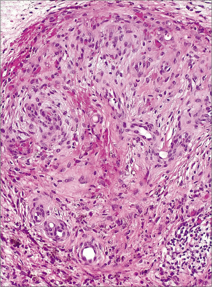 Histopathological image of one of the patients showing an exuberant proliferation of vessels with a lobular configuration. Red blood cell extravasation and hemosiderin deposition can be observed (H and E, ×200)