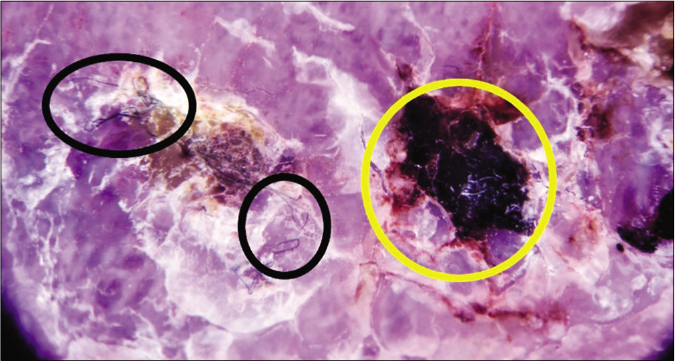 Dermlite DL200 HR with polarized light (×10). Dermoscopic image of patient 1 revealing hemorrhagic crusts (yellow circle) and the “sticky fiber” sign (black circles)