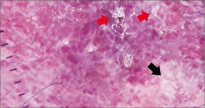 Dermlite DL200 HR with polarized light (×10). Dermoscopic image of patient 3. White shiny structures (black arrows) and superficial scales (red arrows) can be observed