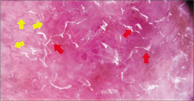 Dermlite DL200 HR with polarized light (×10). Dermoscopic image of patient 4. Irregular vessels (yellow arrows) and superficial scales (red arrows) are pointed out