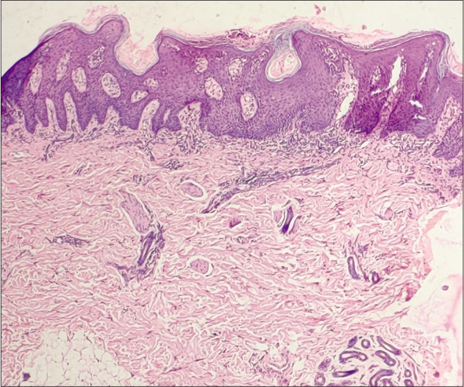 Scanner view showing acanthosis, parakeratosis, elongation of rete ridges, hypogranulosis, collection of neutrophils within the parakeratotic layer with vascular proliferation in papillary dermis and mild-to-moderate chronic inflammatory cell infiltrates in superficial dermis (H&E, 40×)
